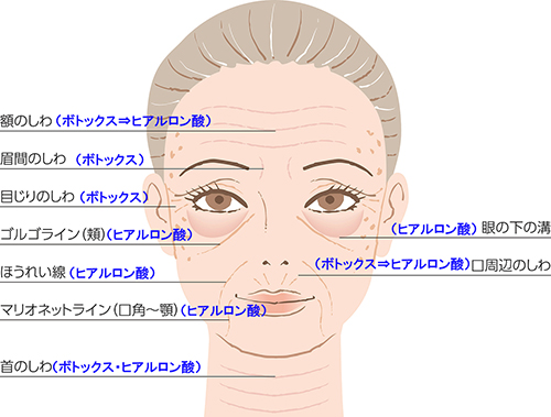 ヒアルロン酸 ボトックス注射 シワのお手入れ 京都市北区の内科 腎臓内科 循環器内科 リウマチ科 大関内科クリニック